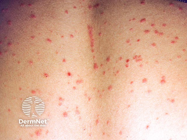 Guttate psoriasis with a linear lesion in the central back developing along the site of a scratch (Koebner phenomenum)