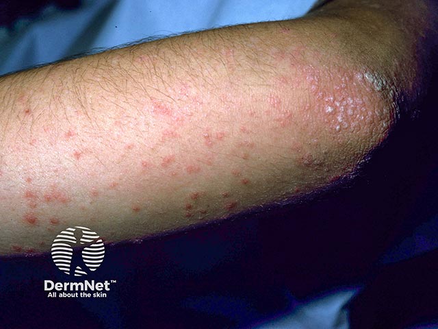 Guttate psoriasis on the arm with coexisting plaque psoriasis on the elbow