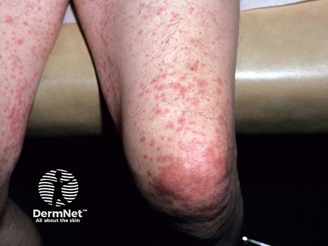Guttate psoriasis on the legs