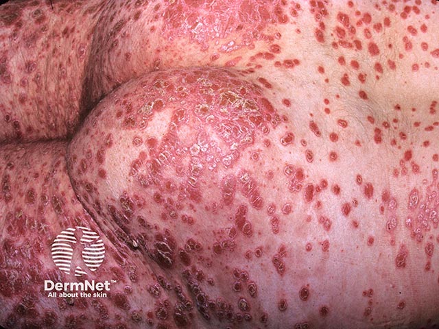 Extensive small plaque psoriasis on the buttocks and back - lesions are brick-red, well-circumscribed and have overlying scale