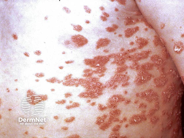 Guttate psoriasis on the trunk - lesions are brick-red, well-circumscribed and scaly