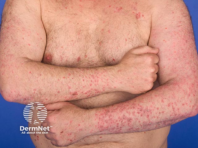 Guttate psoriasis on the arms and trunk - individual papules are coalescing in areas.