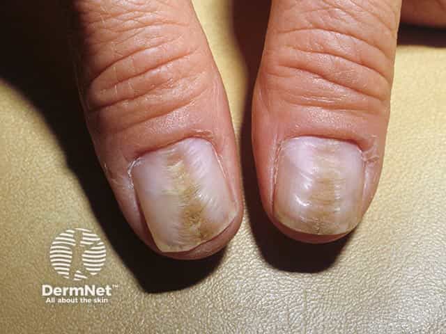 Rippling of the central part of the thumbnail plate and loss of the cuticle in habit-tic nail