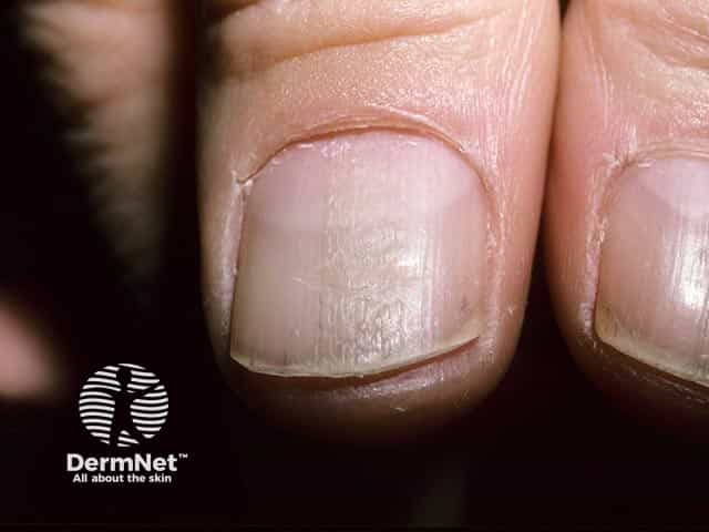 Permanent nail dystrophy following cessation of trauma