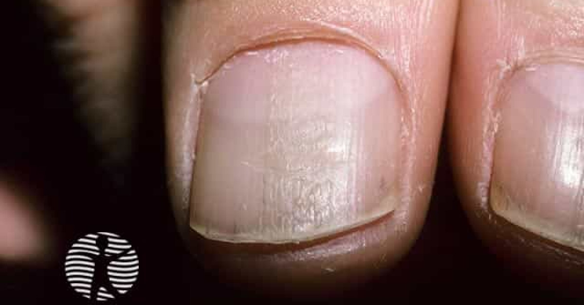 Habit-tic nail deformity image