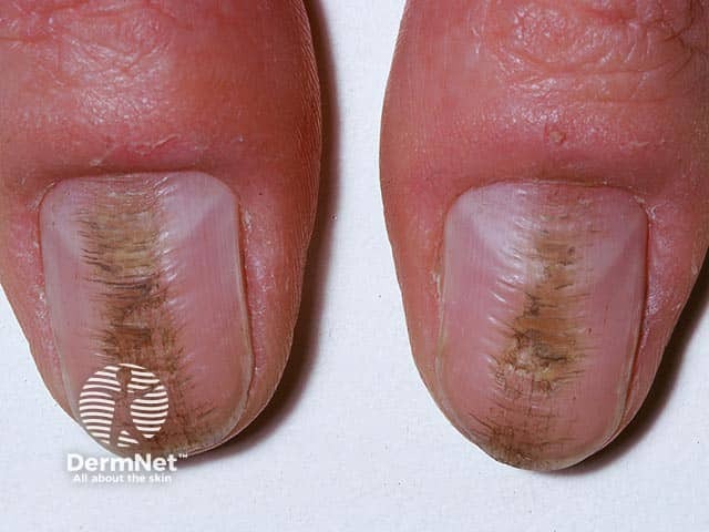 Rippling of the central part of the thumbnail plate and loss of the cuticle in habit-tic nail