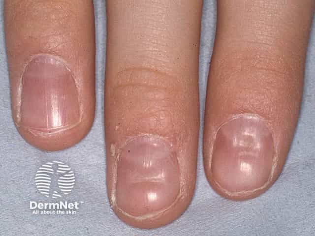 Central nail plate indentations of several fingernails due to repetitive picking of the proximal nail fold