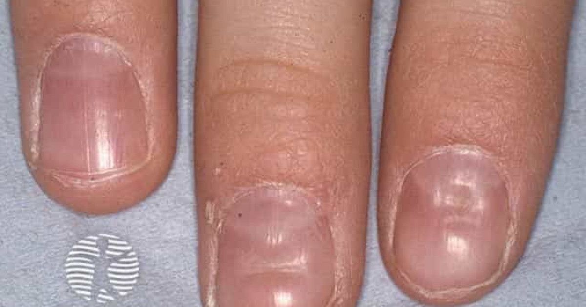 Habittic nail deformity image
