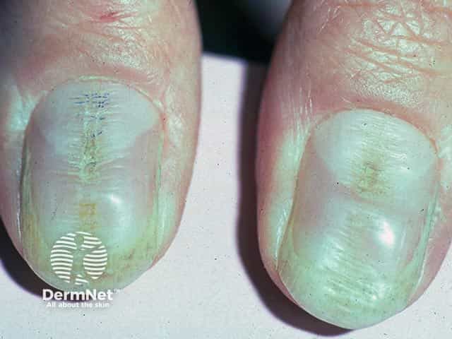 Rippling of the central part of the thumb nail plate and loss of the cuticle in habit-tic nail