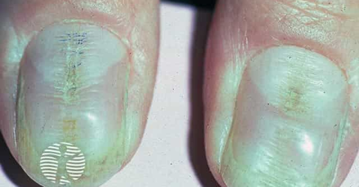 Habit-tic nail deformity image