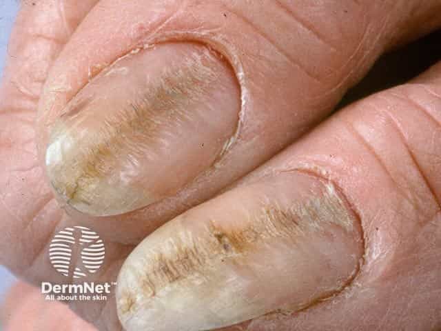 Rippling of the central part of the thumbnail plate and loss of the cuticle in habit-tic nail