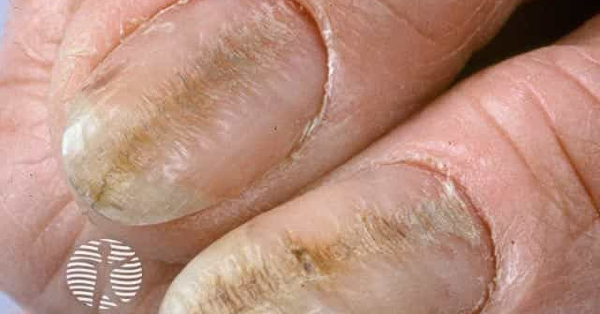 Habittic nail deformity image