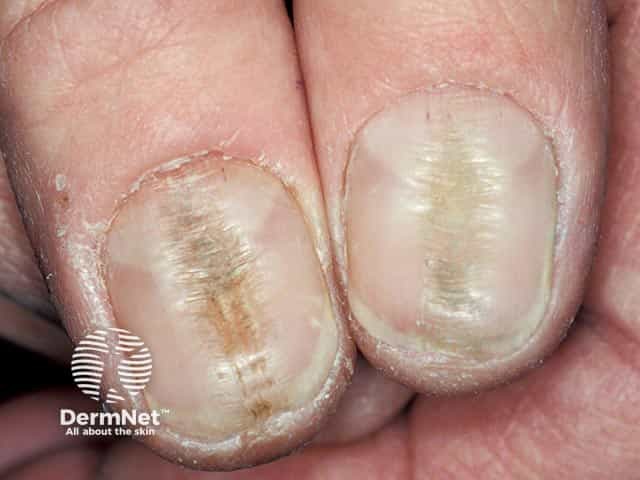 Rippling of the central part of the thumbnail plate and loss of the cuticle in habit-tic nail