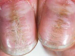 Habit-tic nail deformity