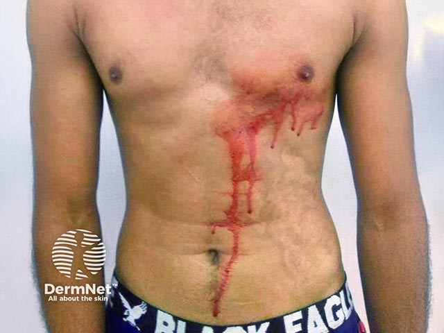 Blood-stained eccrine sweat on the torso due to haematohidrosis
