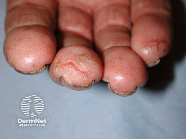 Fissuring, hyperkeratosis and vesiculation in chronic fingertip dermatitis