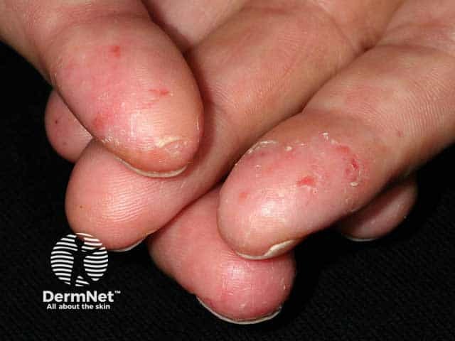Fissuring and hyperkeratosis in chronic fingertip dermatitis