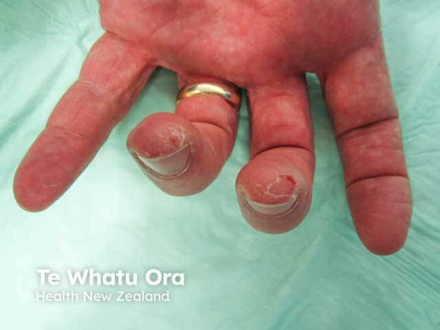 Peeling and hyperkeratosis in chronic fingertip dermatitis