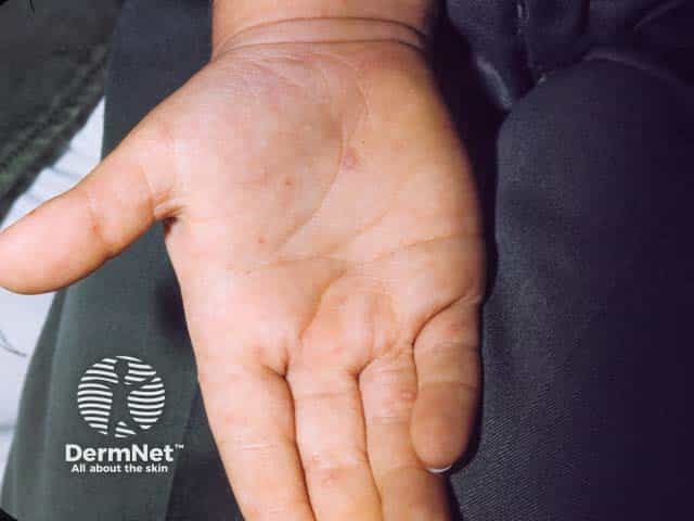 Oval vesicles on the palm in hand, foot and mouth disease