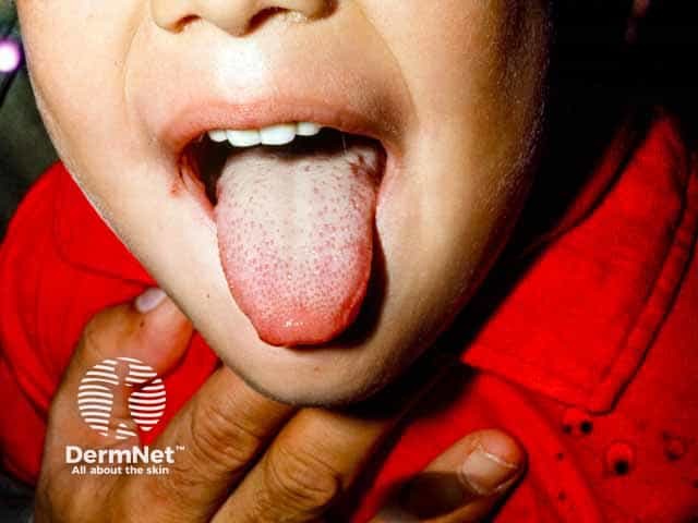 Lingual tip vesicles in hand, foot and mouth disease