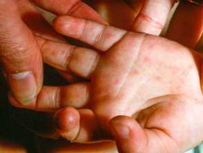 Hand, foot, and mouth disease 
