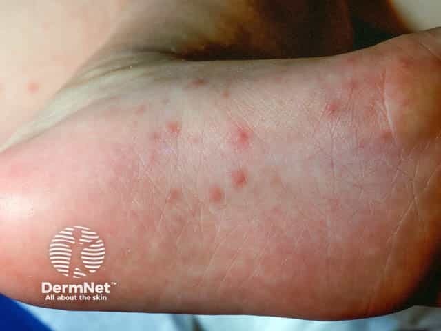 Pre-vesicular plantar lesions in hand, foot and mouth disease