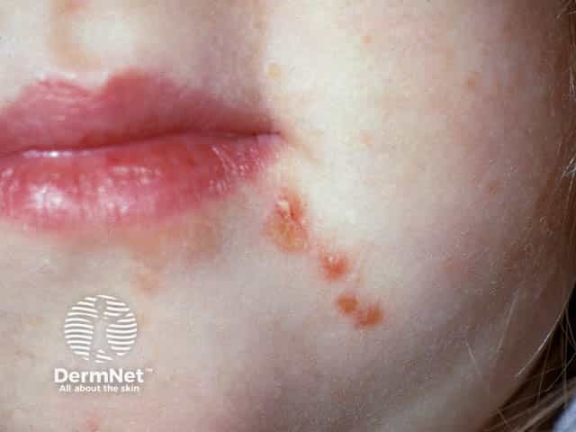 Facial vesicles in hand, foot and mouth disease