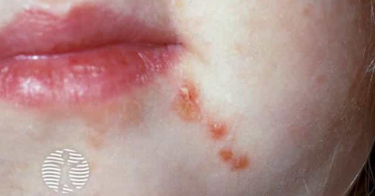 Hand, foot, and mouth disease image