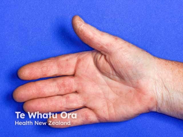 Palmar lesions in hand, foot and mouth disease