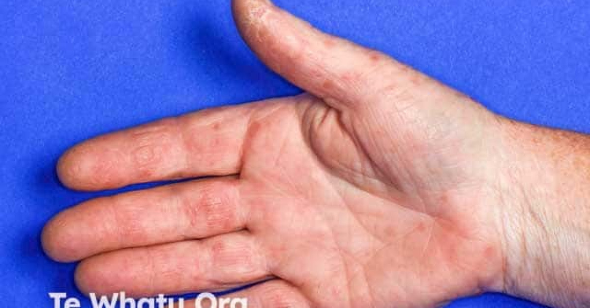 Hand, foot, and mouth disease image