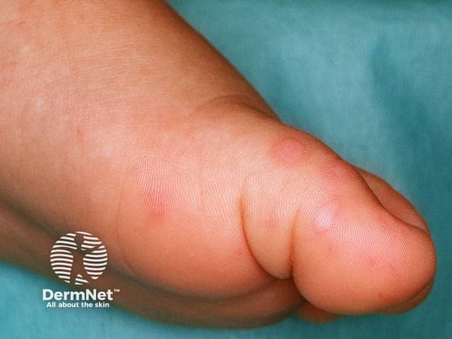 Oval vesicles on the sole in hand, foot and mouth disease
