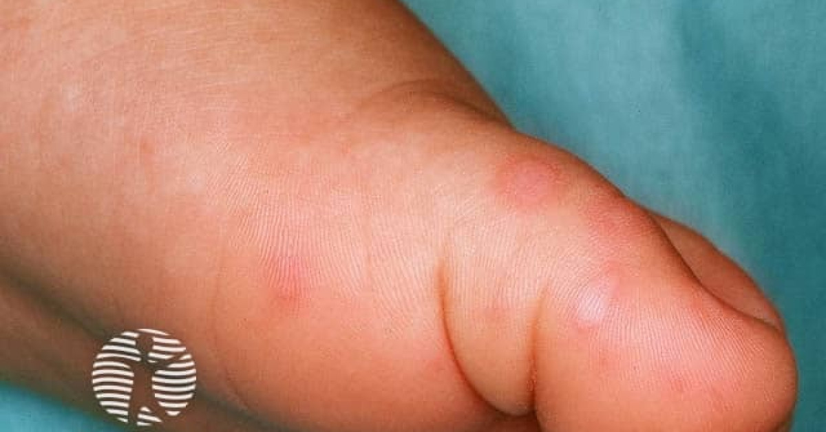 Hand, foot, and mouth disease image