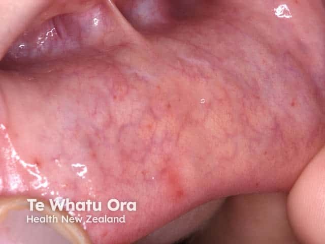 Pre-vesicular erythema on the labial mucosa in hand, foot and mouth disease