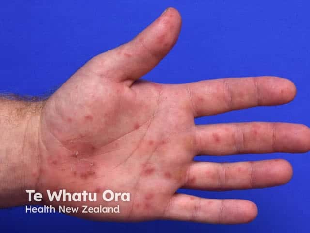 Multiple vesicles and post vesicular scaly patches in palmar hand, foot and mouth disease