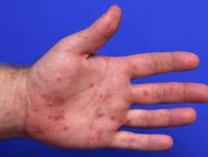 Hand, foot, and mouth disease 