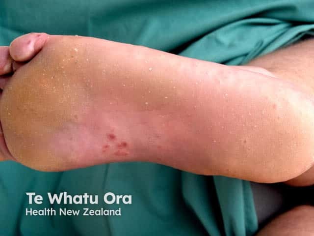 Lesions of hand, foot and mouth disease on the instep and toes