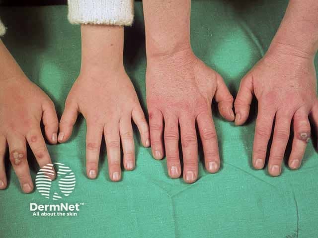 Vesicles in a father and daughter on the dorsal hands in hand, foot and mouth disease