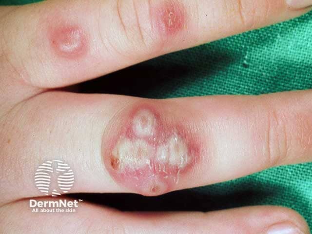 Hand, foot and mouth disease vesicles on the dorsal hands
