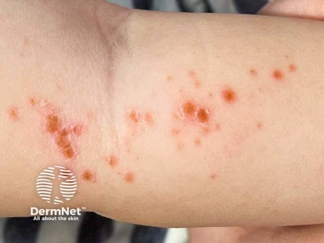 Blisters on the lower leg and antecubital fossa in hand, foot and mouth disease