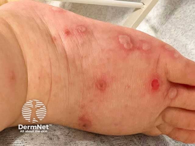 Blisters on the dorsal foot in hand, foot and mouth disease