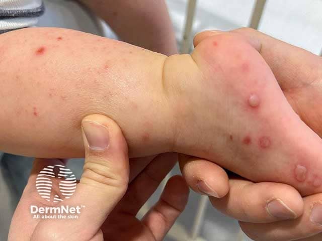 Acral blisters due to hand foot and mouth disease