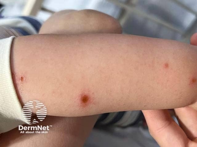 Blisters extending up the arm in hand, foot and mouth disease