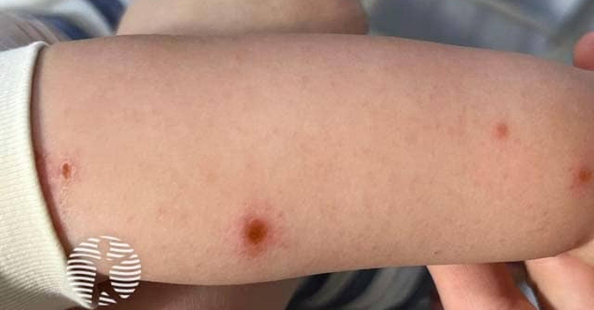 Hand, foot and mouth disease image