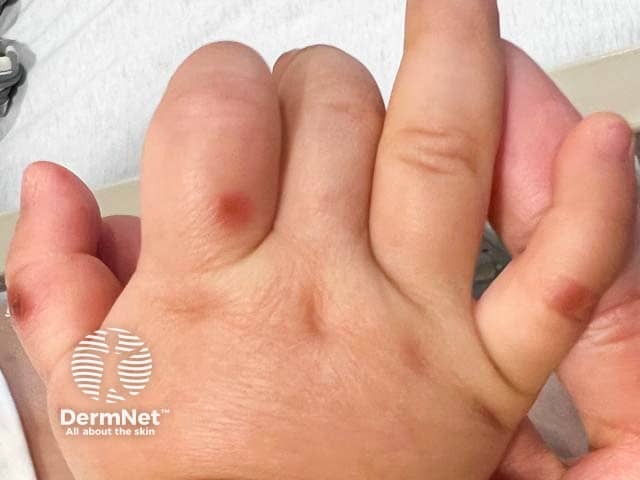 Dorsal hand blisters in hand, foot and mouth disease
