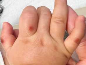 Hand, foot and mouth disease