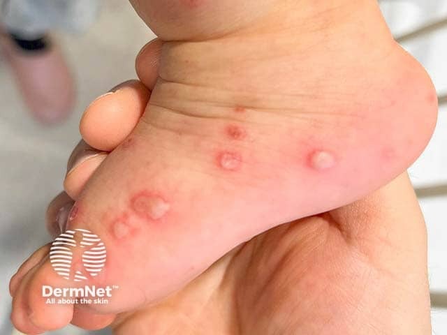 Florid blisters in hand, foot and mouth disease on the foot
