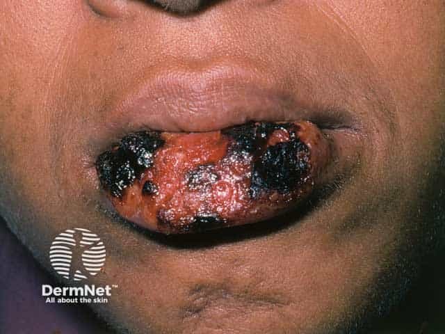 Extenive lip erosions due to chronic herpes simplex infection in HIV