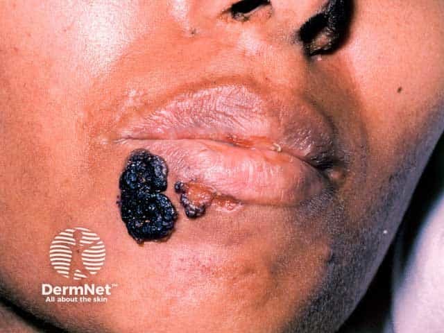 Crusting and erosions due to herpes simplex infection in HIV