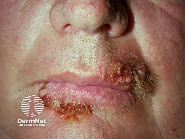 Chronic herpes simplex virus infection on the lip in HIV