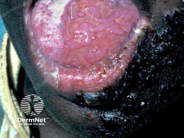 Lingual varicella zoster infection of the left side of the tongue in HIV infection